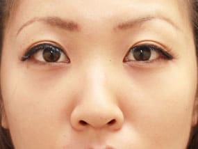 目の下のクマ・タルミ症例手術③手術直後