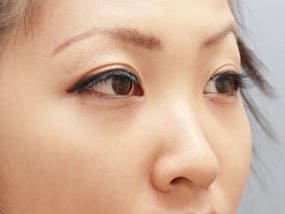 目の下のクマ・タルミ症例手術③-2手術直後