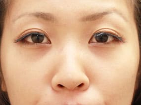 目の下のクマ・タルミ症例手術④手術3日後