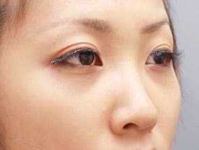 目の下のクマ・タルミ症例手術④-2手術3日後