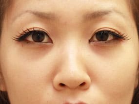 目の下のクマ・タルミ症例⑤手術1週間後