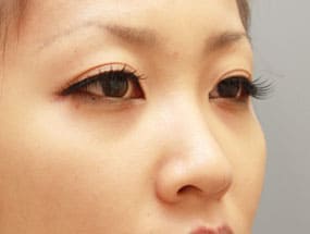 目の下のクマ・タルミ症例⑤-2手術1週間後