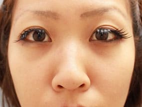 目の下のクマ・タルミ症例⑥手術2週間後