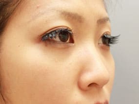 目の下のクマ・タルミ症例⑥-2手術2週間後