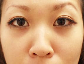 目の下のクマ・タルミ症例⑦手術1ヵ月