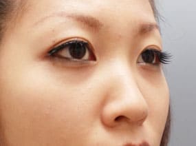 目の下のクマ・タルミ症例⑦-2手術1ヵ月