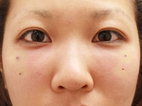 目の下のクマ・タルミ症例⑧手術1ヵ月