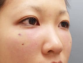 目の下のクマ・タルミ症例⑧-2手術1ヵ月