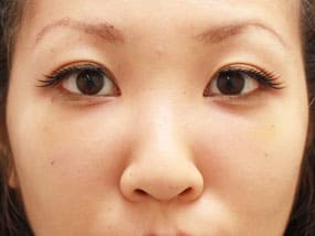 目の下のクマ・タルミ症例⑨手術1ヵ月