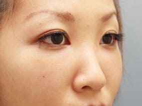 目の下のクマ・タルミ症例⑨-2手術1ヵ月