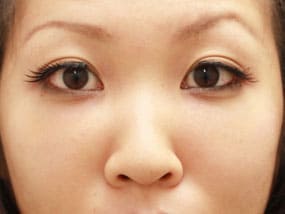 目の下のクマ・タルミ症例⑩手術1ヵ月