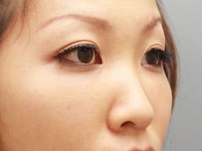 目の下のクマ・タルミ症例⑩-2手術1ヵ月