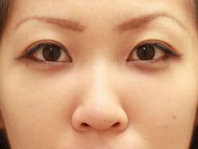 目の下のクマ・タルミ症例⑪手術1ヵ月