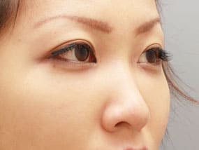 目の下のクマ・タルミ症例⑪-2手術1ヵ月