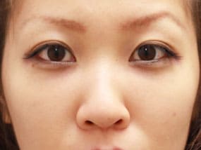 目の下のクマ・タルミ症例⑫手術1ヵ月