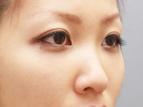 目の下のクマ・タルミ症例⑫-2手術1ヵ月