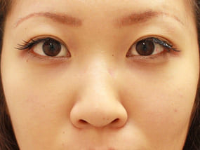 目の下のクマ・タルミ症例⑬手術3ヵ月後