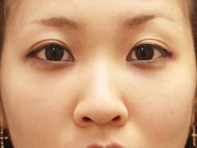 目の下のクマ・タルミ症例⑭手術3ヵ月後