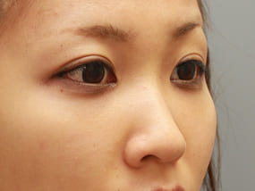 目の下のクマ・タルミ症例⑭-2手術3ヵ月後)