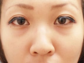 目の下のクマ・タルミ症例①手術前