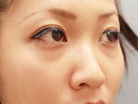 目の下のクマ・タルミ症例①-2手術前