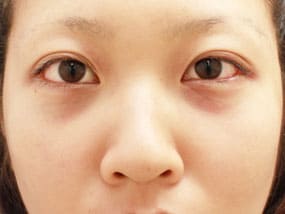 目の下のクマ・タルミ症例②手術デザイン