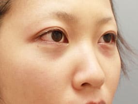 目の下のクマ・タルミ症例手術2週間後