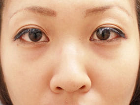 目の下のクマ・タルミ症例手術前-1