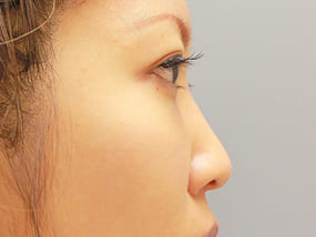 目の下のクマ・タルミ症例脱脂後に脂肪注入 手術2ヶ月後-5