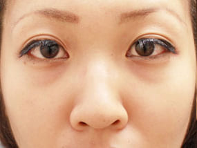 目の下のクマ・タルミ症例手術前-1