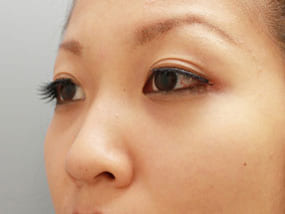 目の下のクマ・タルミ症例経結膜脱脂 手術2ヶ月後-2