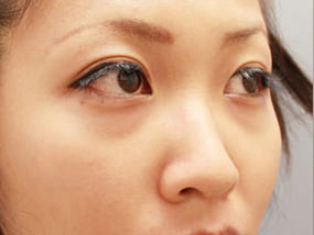 目の下のクマ・タルミ症例手術前-3