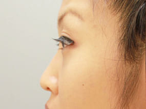 目の下のクマ・タルミ症例手術前-4