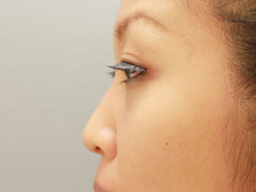 目の下のクマ・タルミ症例経結膜脱脂 手術2ヶ月後-4