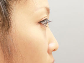 目の下のクマ・タルミ症例手術前-5