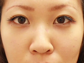 目の下のクマ・タルミ症例脱脂後に脂肪注入 手術2ヶ月後-1