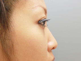 目の下のクマ・タルミ症例経結膜脱脂 手術2ヶ月後-5