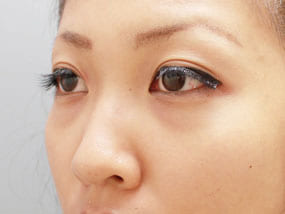 目の下のクマ・タルミ症例手術前-2