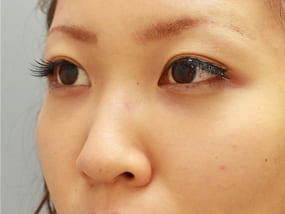 目の下のクマ・タルミ症例脱脂後に脂肪注入 手術2ヶ月後-2