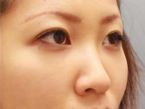 目の下のクマ・タルミ症例脱脂後に脂肪注入 手術2ヶ月後-3