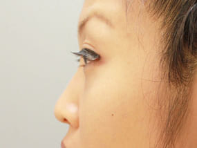 目の下のクマ・タルミ症例手術前-4