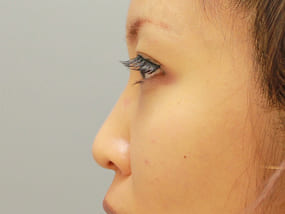 目の下のクマ・タルミ症例脱脂後に脂肪注入 手術2ヶ月後-4