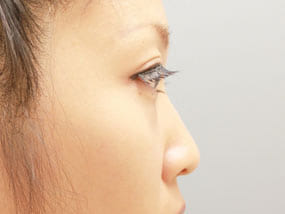 目の下のクマ・タルミ症例手術前-5